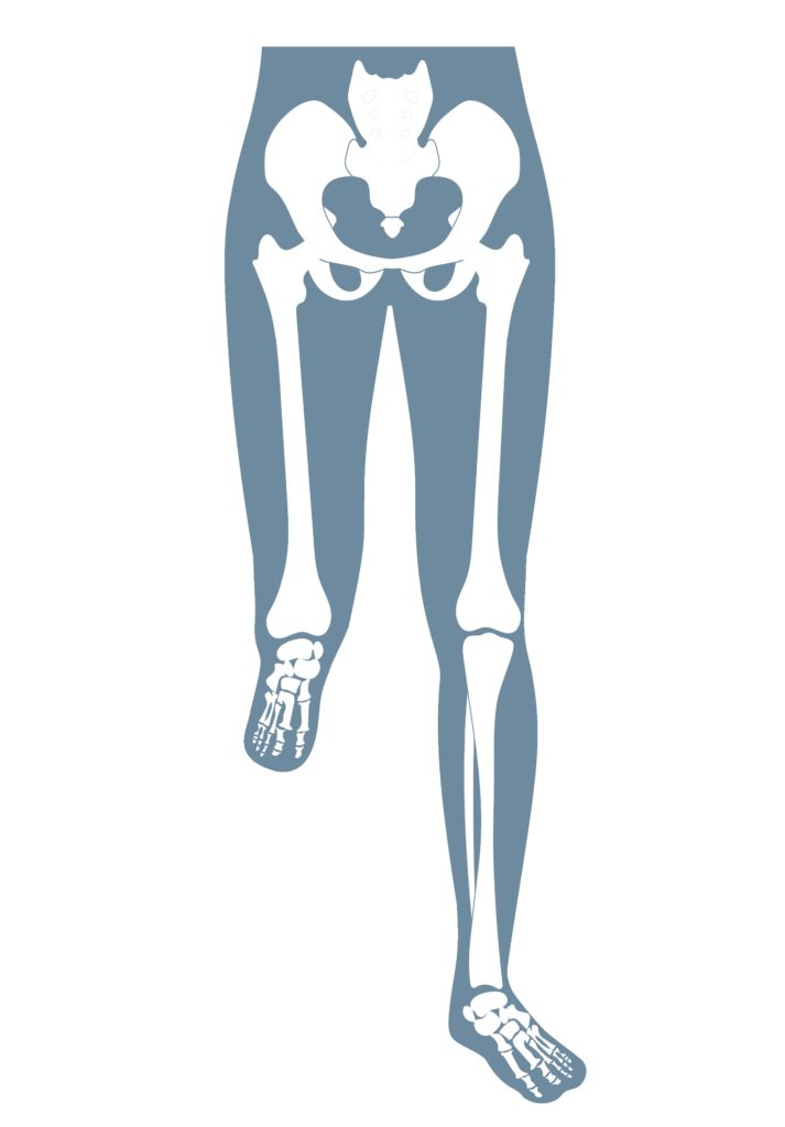 Anatomische Darstellung einer Umkehrplastik nach Borggreve am menschlichen Skelett (Rotation des Unterschenkels).