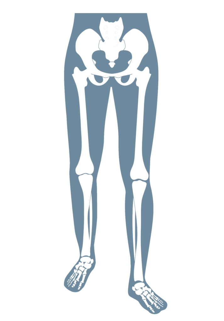 Anatomische Darstellung eines menschlichen Skeletts mit einer angeborenen Fehlbildung am Bein (Dysmelie).