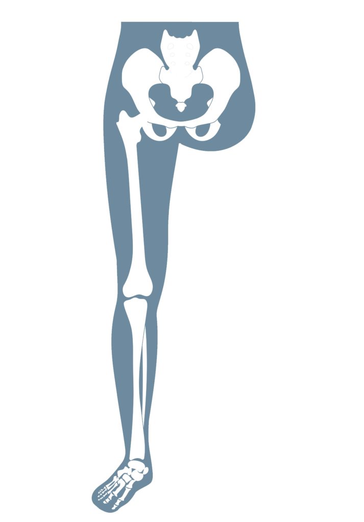 Anatomische Darstellung eines menschlichen Skeletts, das eine Hüftexartikulation zeigt.