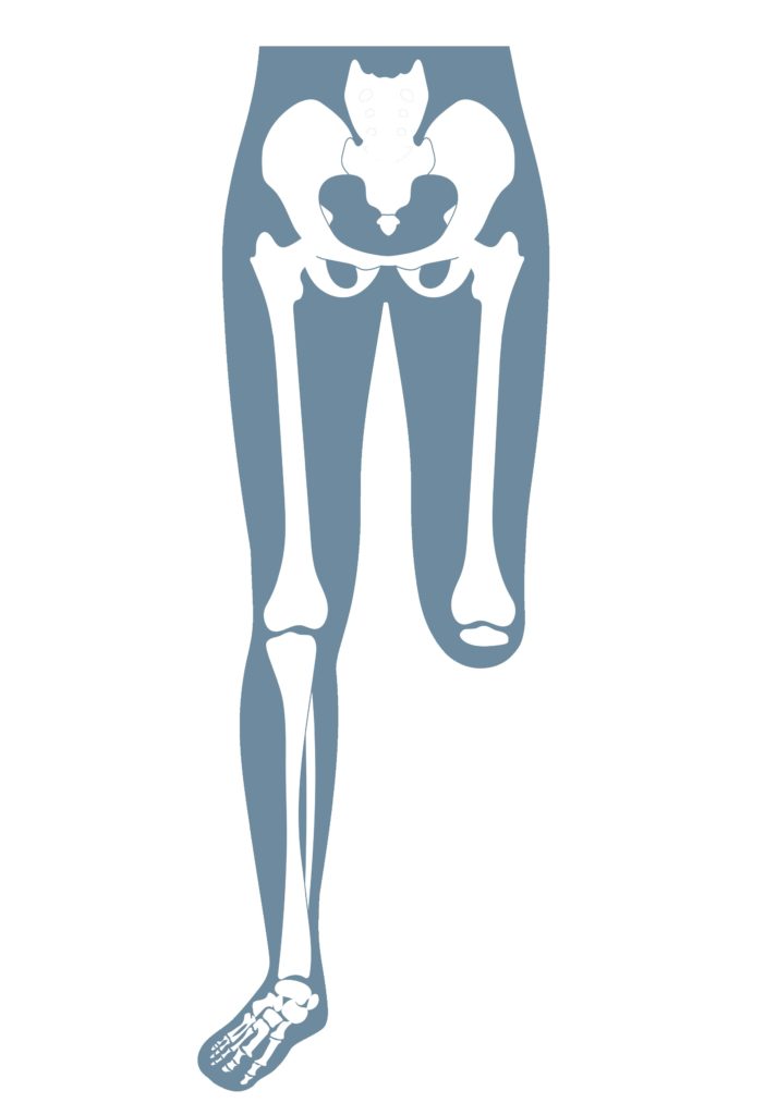 Anatomische Darstellung eines menschlichen Skeletts, das eine Knieexartikulation zeigt.