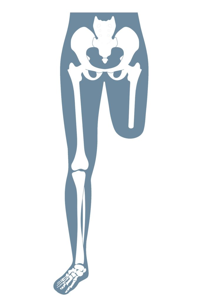 Anatomische Darstellung eines menschlichen Skeletts, das eine Oberschenkelamputation (transfemoral) zeigt.