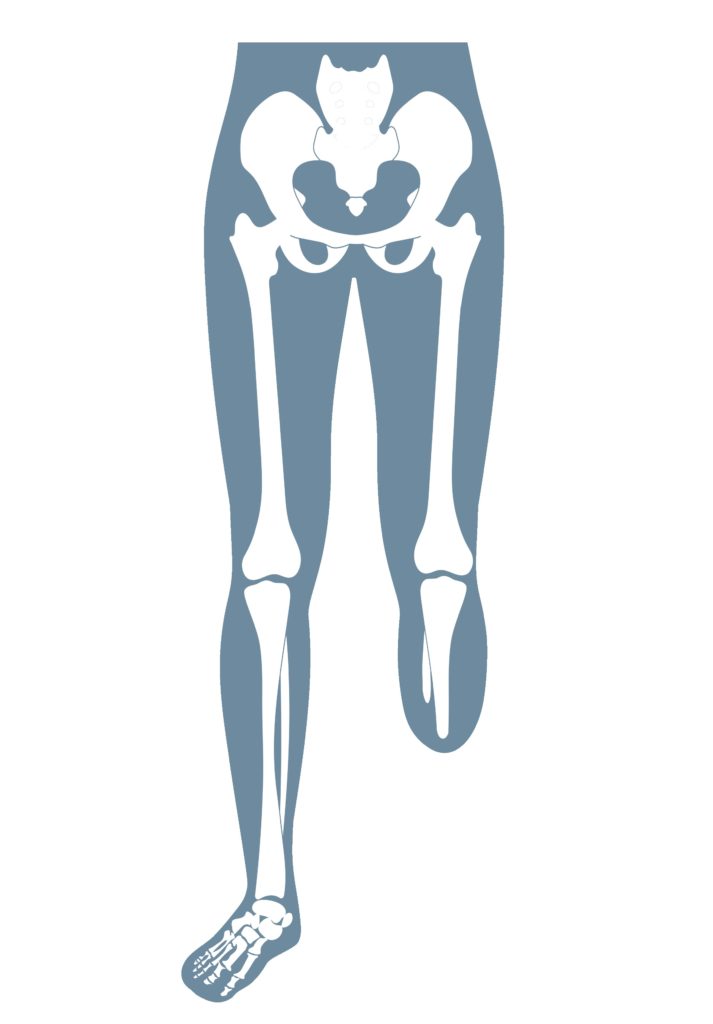Anatomische Darstellung eines menschlichen Skeletts, das eine Unterschenkelamputation (transtibial) zeigt.
