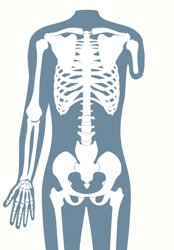 Anatomische Darstellung eines menschlichen Skeletts, das eine Oberarmamputation (transhumeral) zeigt.