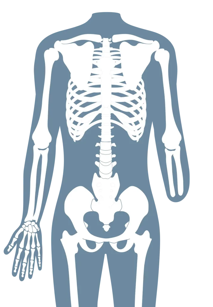 Anatomische Darstellung eines menschlichen Skeletts mit angeborener Fehlbildung (Dysmelie) am Arm.